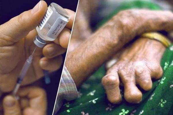 कुष्ठरोग निवारण घोषणाको १० वर्ष, रोगीको संख्या बढ्दै